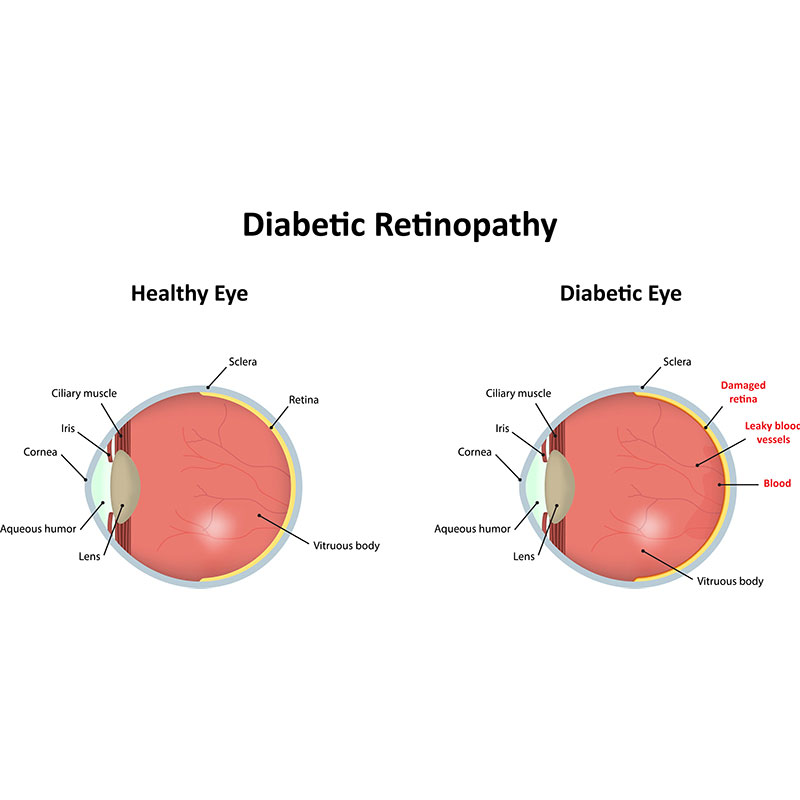 Diabetic Eye Care | Erie, PA | Erie Eye Clinic